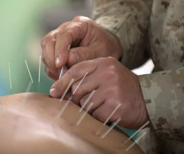 Acupuncture therapy at Highland